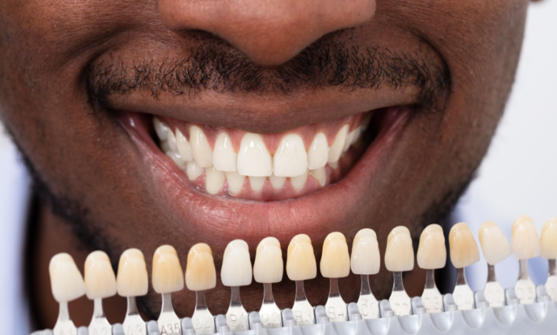 Veneers: Enhancing Oral Wellness Through Custom Solutions